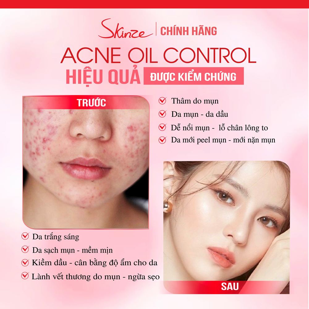 Kem dưỡng da dầu mụn Skinze Acne Oil Control kiềm dầu ngừa mụn giảm thâm mụn trắng da dưỡng ẩm